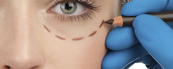 Blefaroplastia - Párpados superiores e inferiores