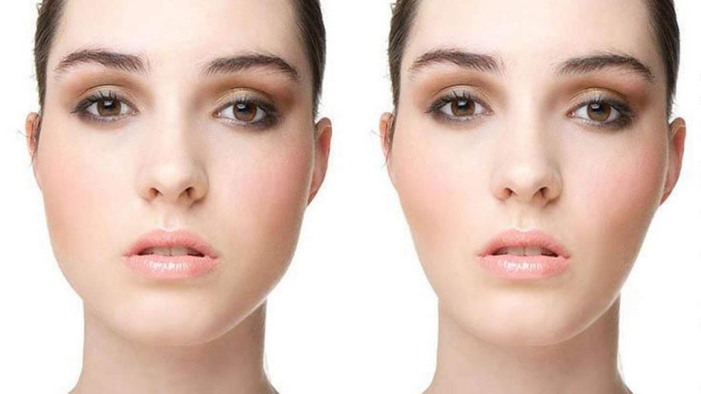 Bichectomia - Dr. Jorge Urenda - Resultados