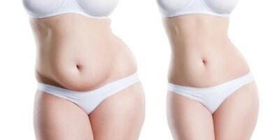 Abdominoplastia - Vista Frontal - Dr. Jorge Urenda