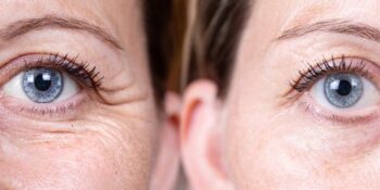 Blefaroplastia - Dr. Jorge Urenda - Antes y después