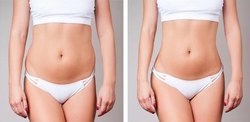 Liposucción - Vista_Frontal - Dr. Jorge Urenda
